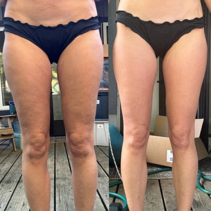 Culmtree™ - Cellulite & Circulation Boost Massager